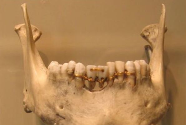 4천년 전 치과기술