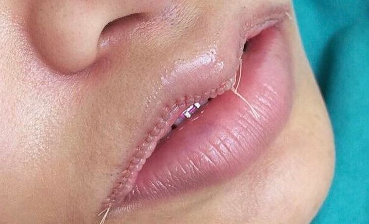 입술축소수술