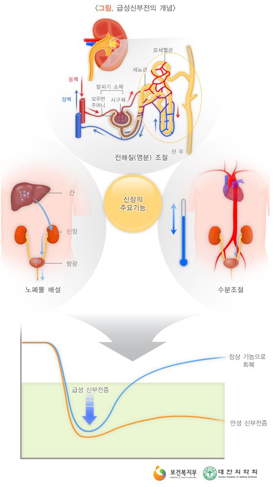 급성신부전증