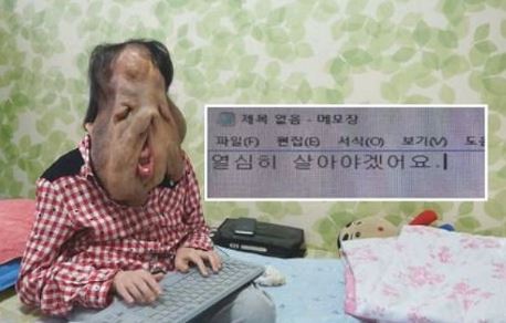 심현희 세상에 이런일이 신경섬유종 2