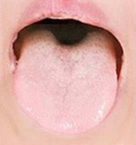 혀색깔4