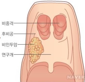 김우빈 비인두암 2