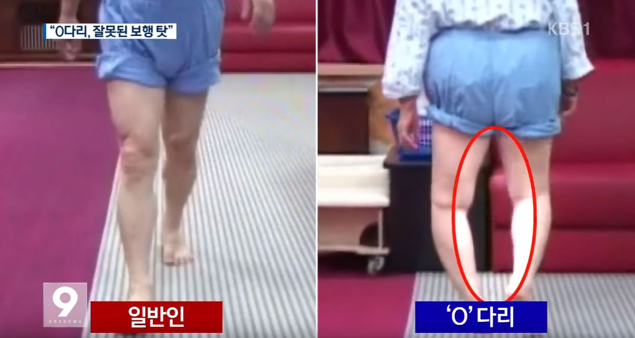 오다리 원인