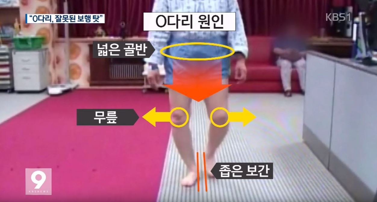오다리 원인2