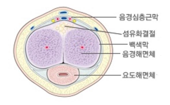 음경곡만증