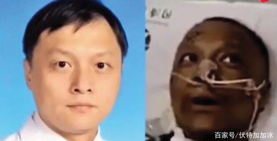 중국 얼굴 검게 변한 코로나 의사 0