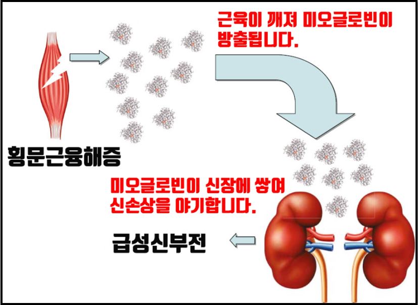 횡문근융회증